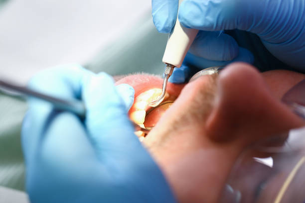 Best Emergency Tooth Extraction in Doffing, TX