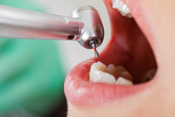 Best Emergency Tooth Extraction in Doffing, TX